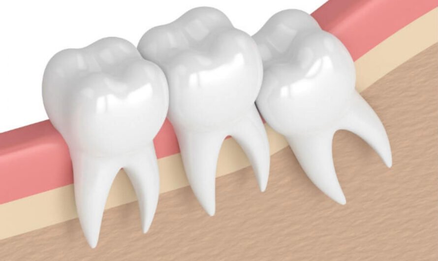 Wisdom Teeth and Bad Breath