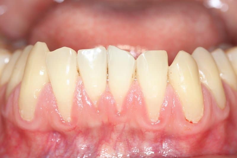 Causes Of Gum Recession