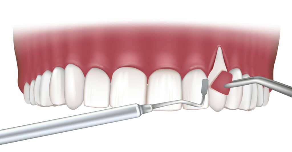 Home treatment for Receding Gums Grow Back